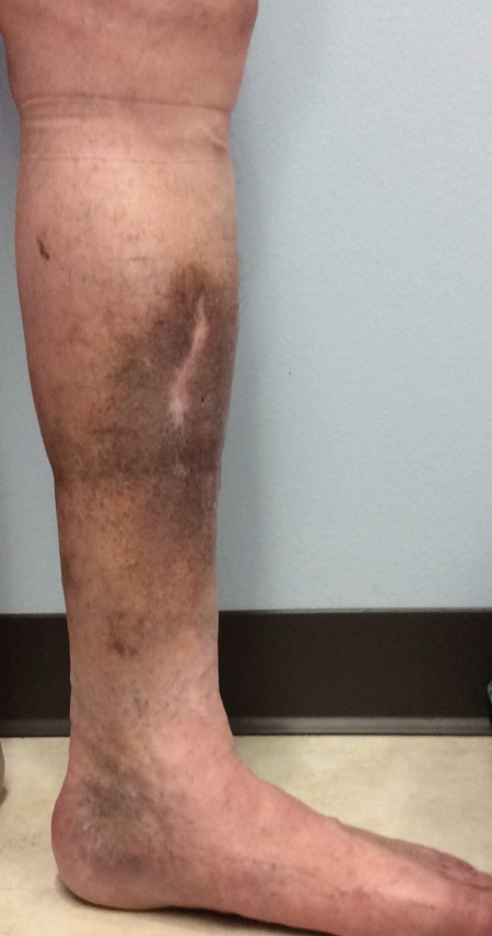 Venous Insufficiency Pictures Images A Visual Guide