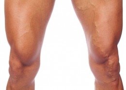 Varicose veins in an athlete's legs after exercising