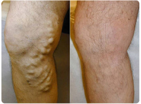 laser_varicose_veins_removal1
