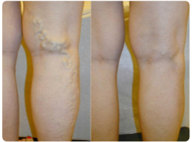 laser_varicose_veins_removal2