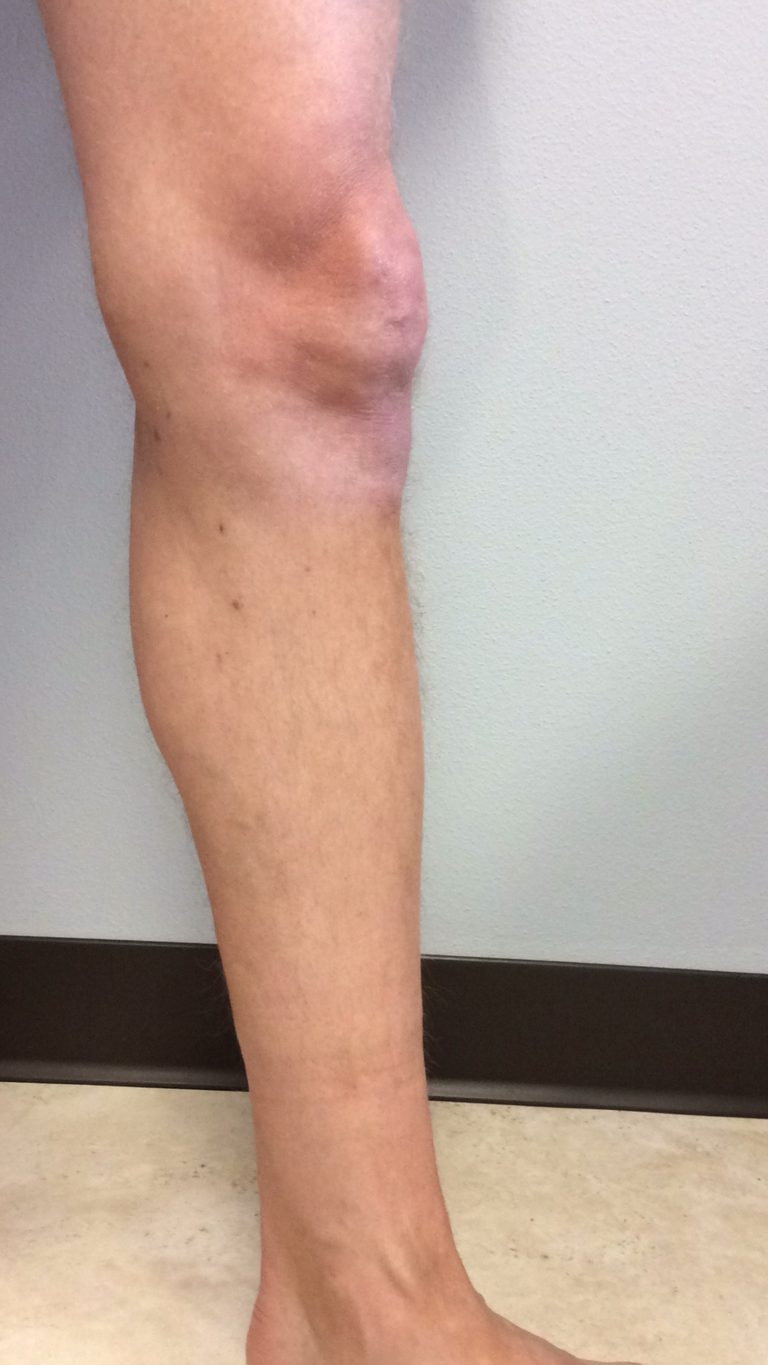 Varicose Veins Before and After Pictures & Images Surgery