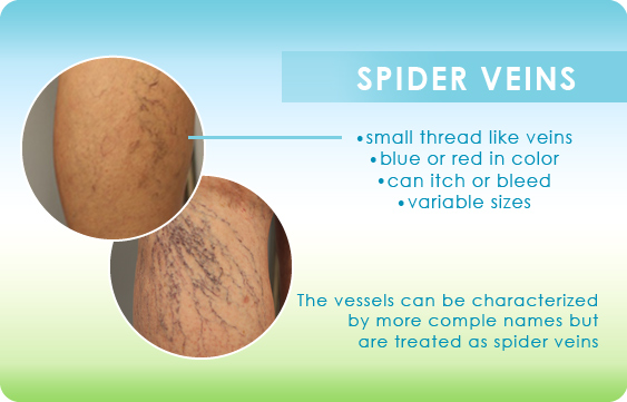 Graphic illustrating the difference is between varicose and spider veins