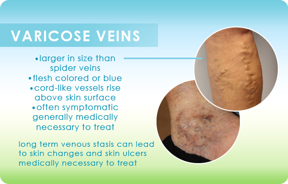 Summary graphic showing what the difference is between spider veins and varicose veins