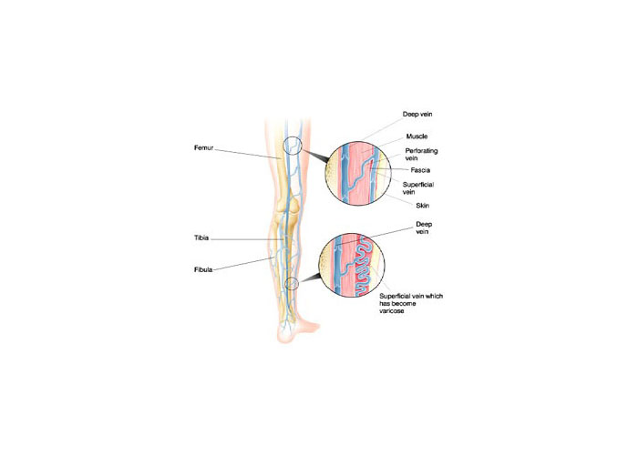 superficial and perforating veins of the lower limb vizualizai tratamentul din varicoza