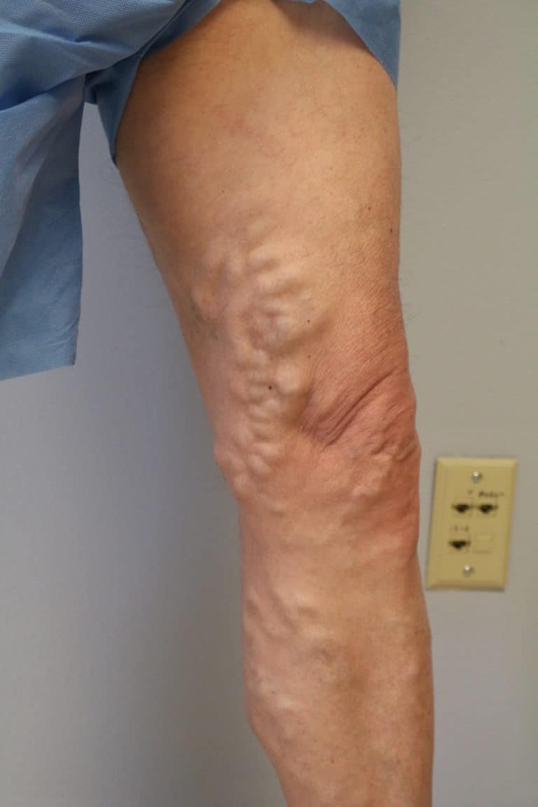 Varicose Veins Before and After Pictures & Images Surgery & Treatment