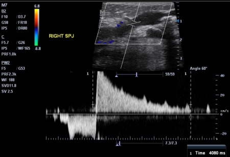 Varicose Veins Ultrasound: Vein Mapping: Mequon, Wisconsin