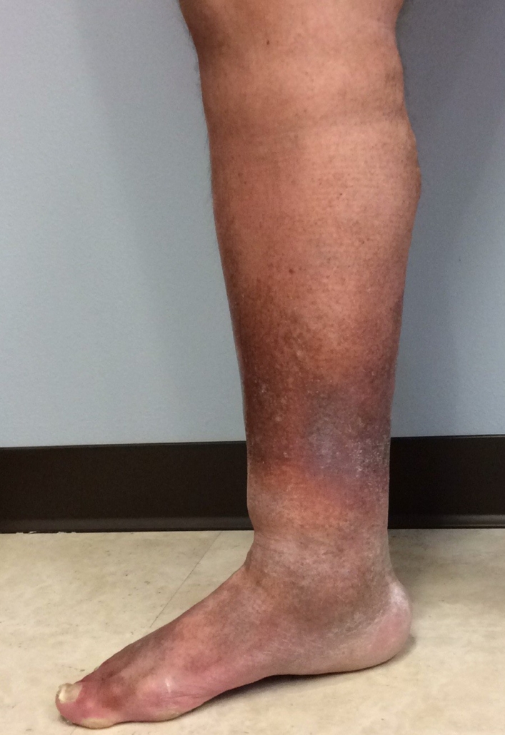 leg-discoloration-stasis-dermatitis-health-life-media