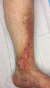 lower leg image showing chronic venous insufficiency with varicose eczema