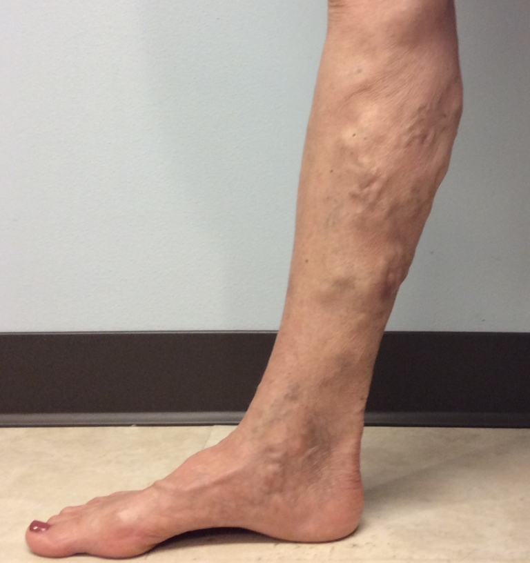 Venous Insufficiency Pictures & Images A Visual Guide