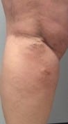 Venous insufficiency picture with varicose veins and inflammation seen with phlebitis