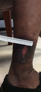 lower leg African American woman with chronic venous insufficiency skin changes and open ulceration