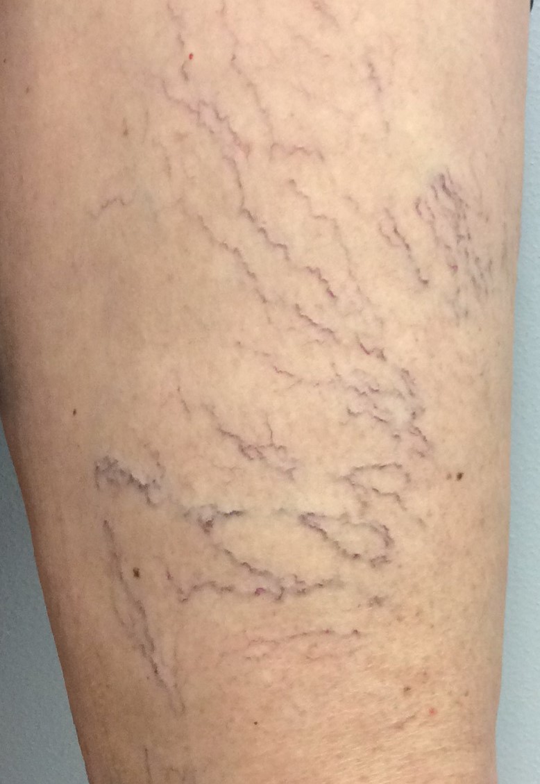 Venous Insufficiency Pictures & Images: A Visual Guide