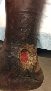 Image of the ankle of a patient with a dangerous complication of varicose veins, a venous insufficiency ulcer