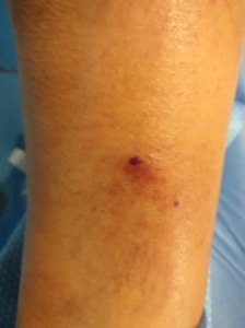 close up picture of a varicose vein that had bled.