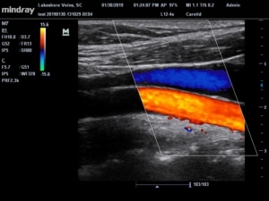  Picture from a vascular ultrasound test showing an artery and a vein