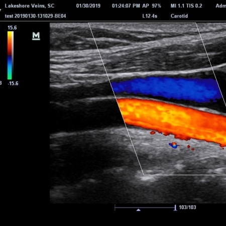 Vascular Ultrasound: What Is It, How It's Performed & Other Test Info