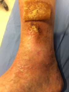 Right inner lower leg with an ulcer that does not heal