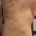 Picture of the right outside knee in a person with leg vein pain taken at a Mequon, Wisconsin vein clinic