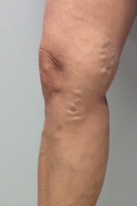 picture of the right knee from a patient at a Mequon, Vein Clinic with painful varicose veins