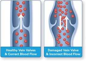 Schematic of a health vein valve versus a damaged vein valve