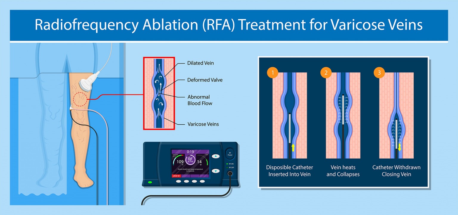 Radiofrequency Ablation Near Me Endovenous Laser Mequon, WI